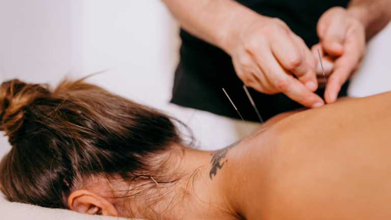 acupuncture