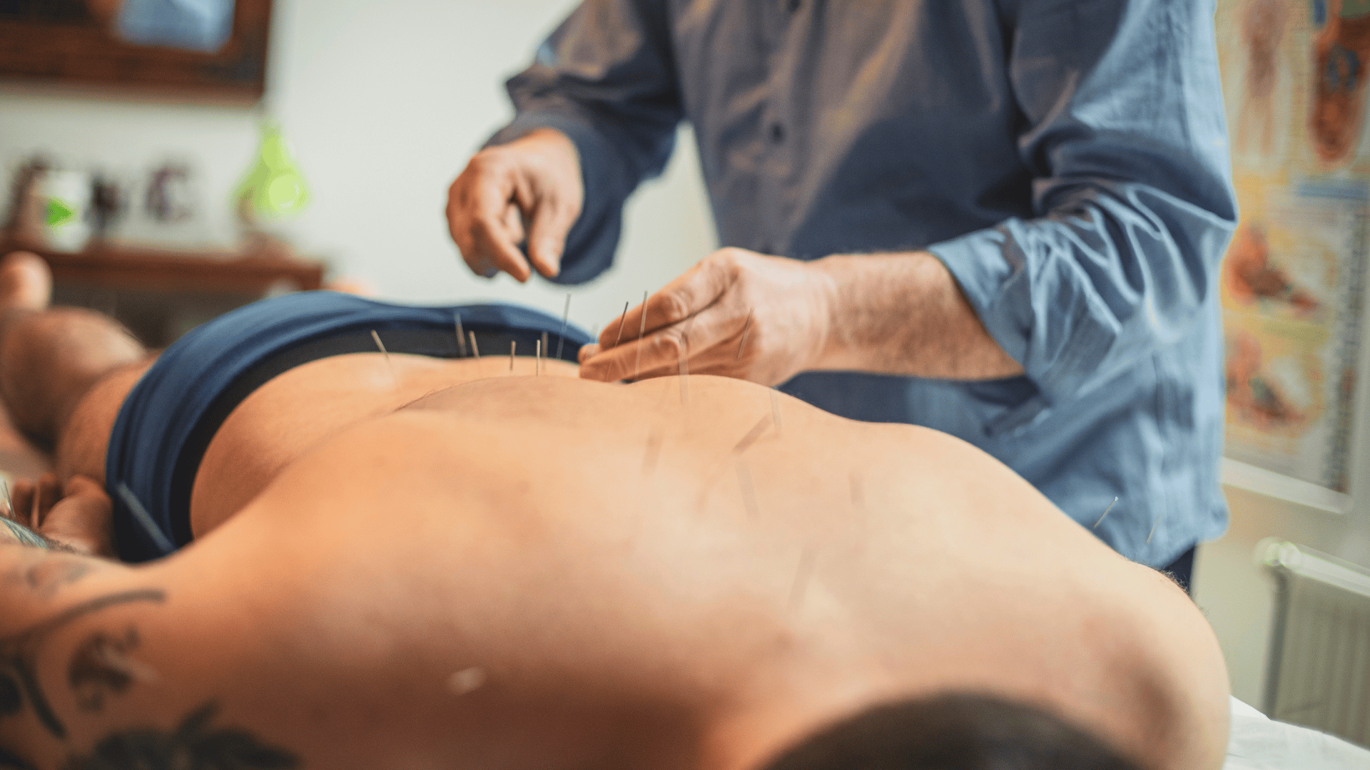 acupuncture